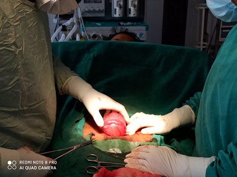 Right Ovarian Cyst&quot; को &quot;Cystectomy with Right Salpingectomy